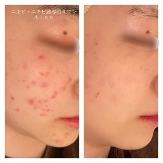 ニキビ跡専門サロン Ａｉｎａのエステ・リラクイメージ