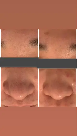 肌質改善ハーブピー リング🌿RINAのエステ・リラクイメージ