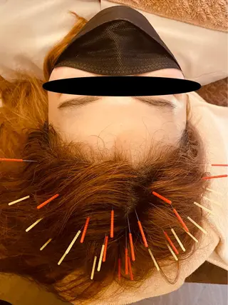 ロング Acupuncture  salon LINOA リノア鍼灸院所属・ヘッドスパ鍼/小顔鍼 耳ツボ 　LINOAのエステ・リラクイメージ