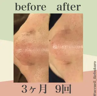 皮膚科より効果あり ⁉️最短ニキビ改善のエステ・リラクイメージ