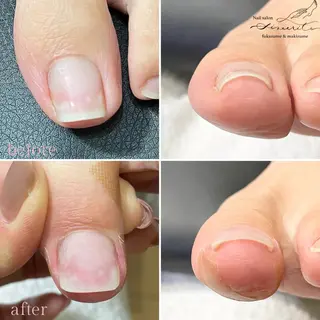 ネイル 深爪・巻き爪 専門サンセリテのネイルデザイン