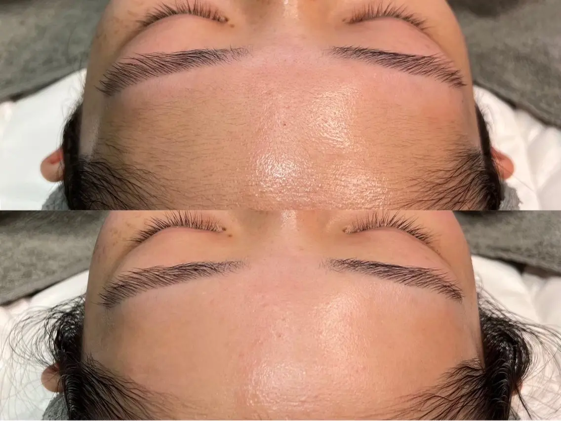 フルフェイスWAX顔脱毛+贅沢ジェルパック🫧の写真
