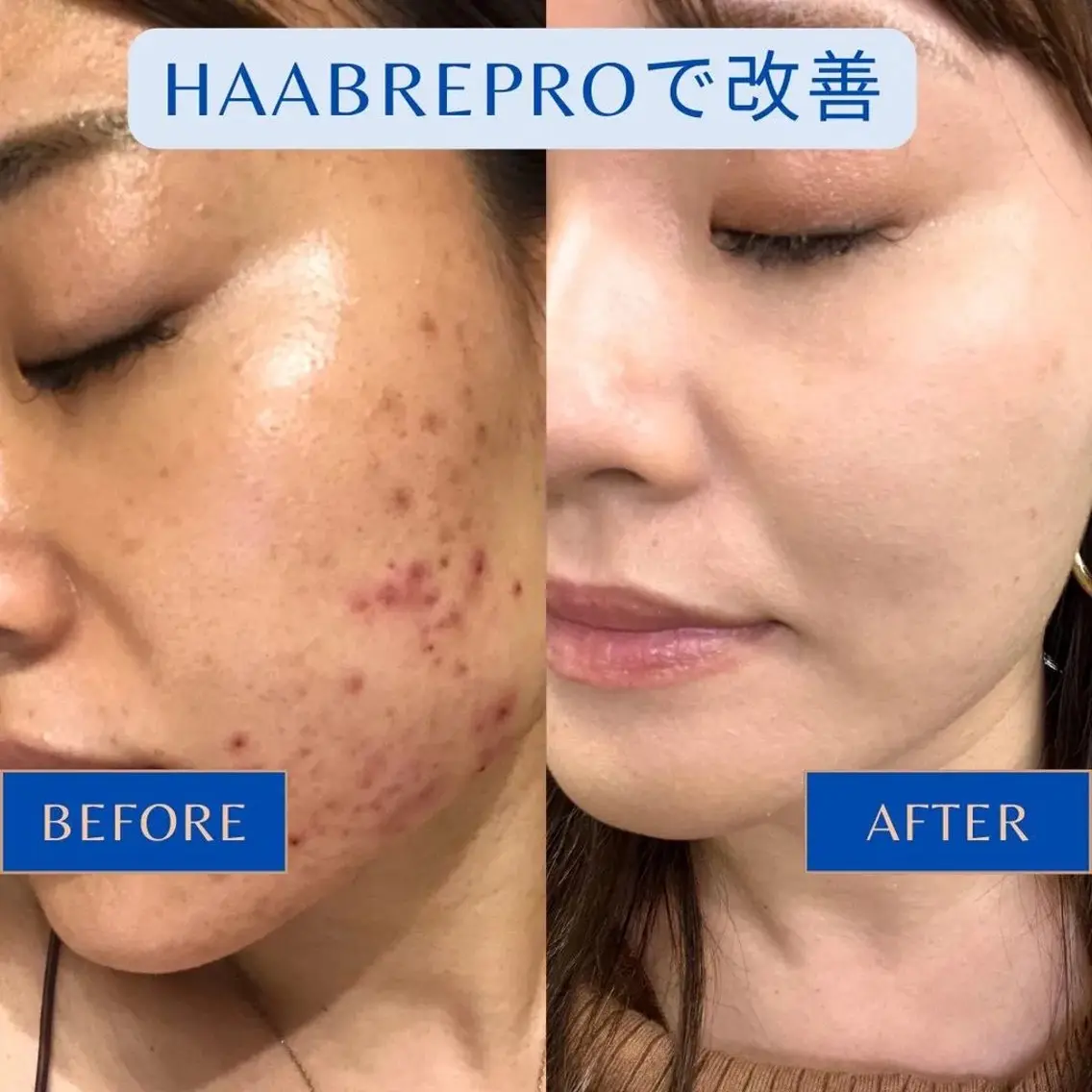 【7月限定🌿技術研修モニター】本気の肌質改善｜HAABハーブリプロ ¥15,000の写真