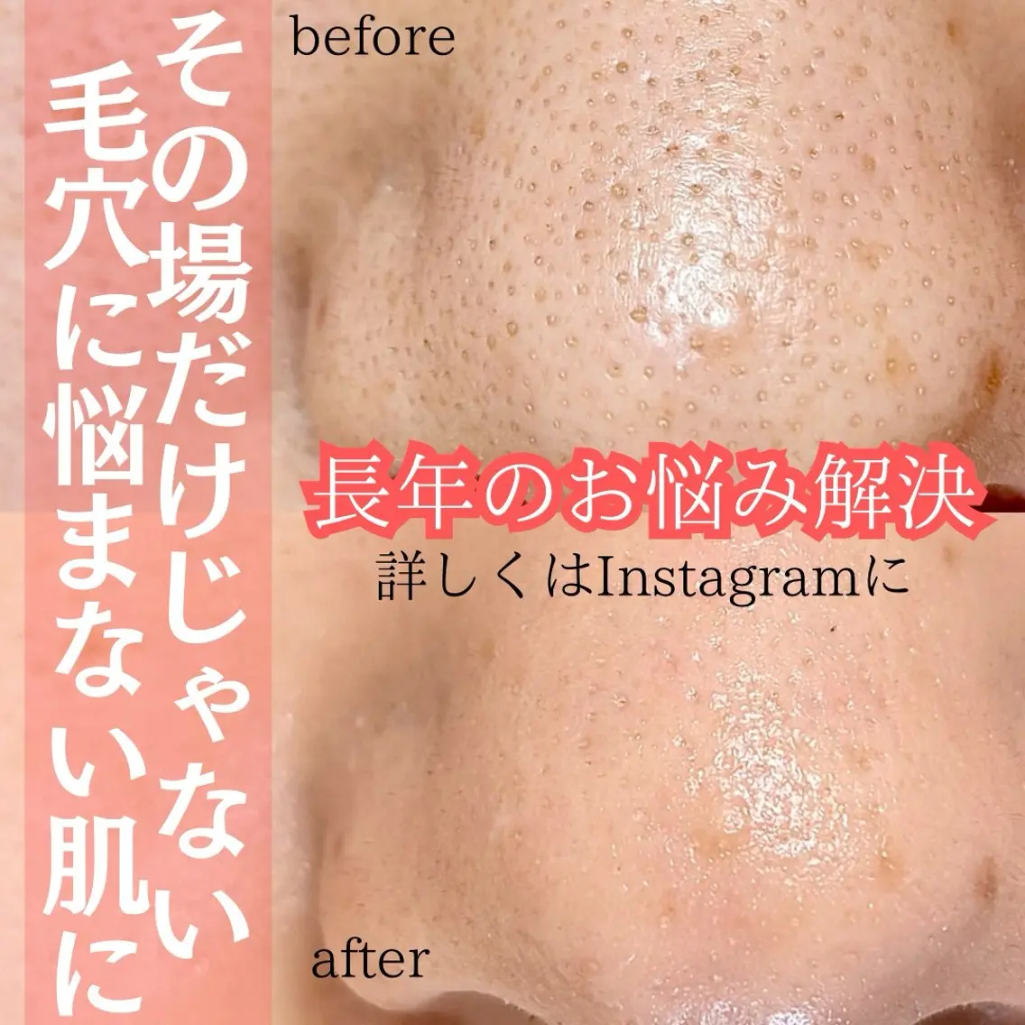 徹底毛穴ケア導入価格の写真