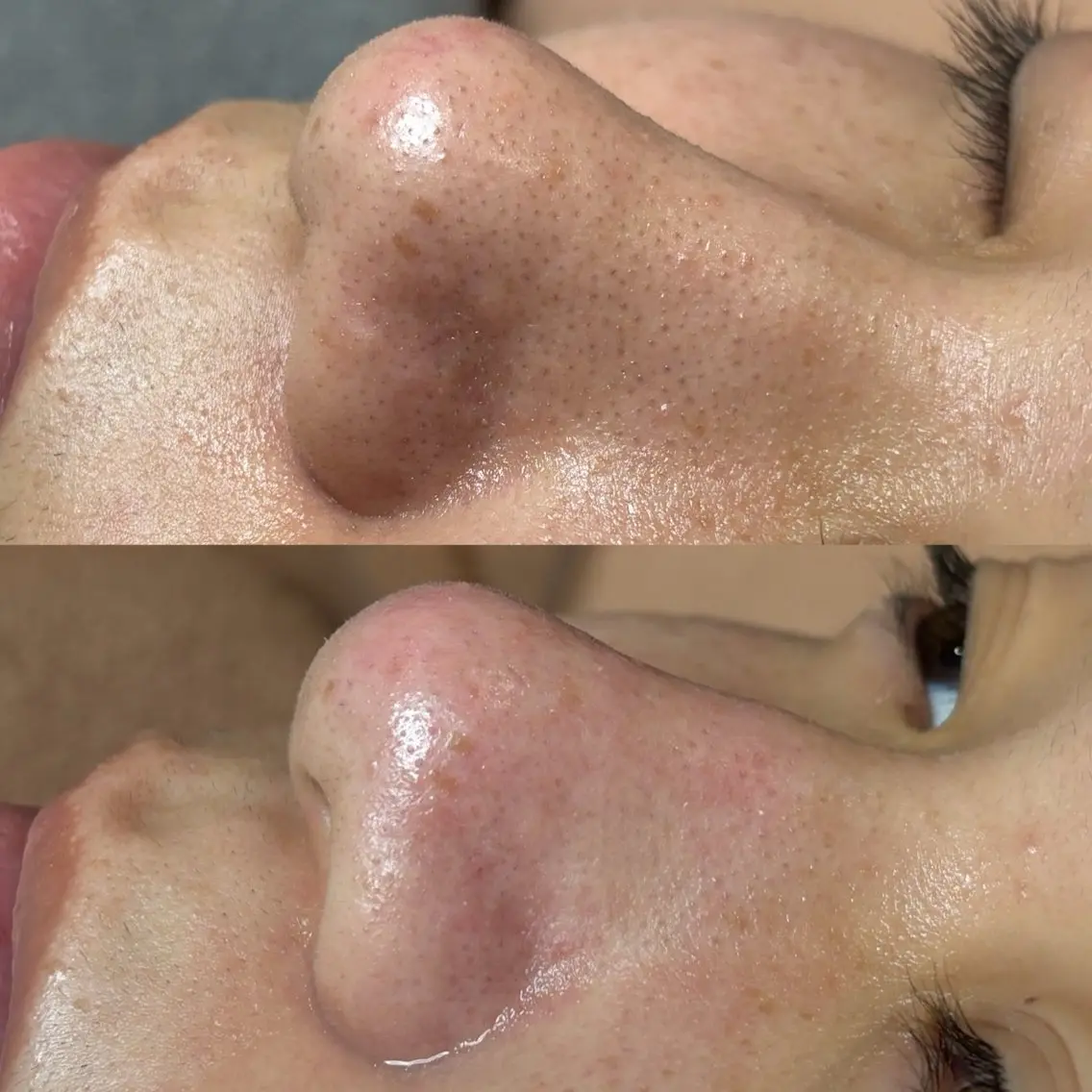 【毛穴SPメニュー】プラズマシャワー🚿✖︎毛穴洗浄💧✖︎トラネキサム酸&美容液導入付きの写真