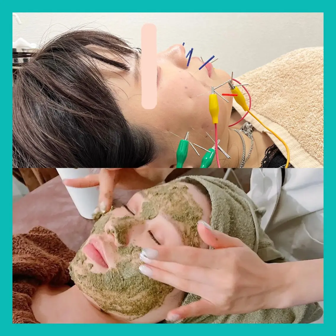 【肌質改善×リフトアップ】🫧ハーブピーリングx電気美容鍼🫧肌荒れトーンアップ浮腫みリフトアップの写真