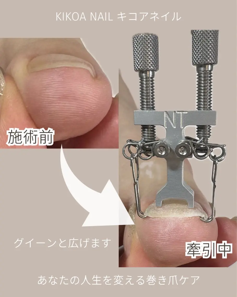 【男性歓迎】初回お試し・巻き爪・変色・剥離等ﾄﾗﾌﾞﾙﾈｲﾙ改善・痛みも見た目も即効改善(ﾓﾆﾀｰ様募集).の写真