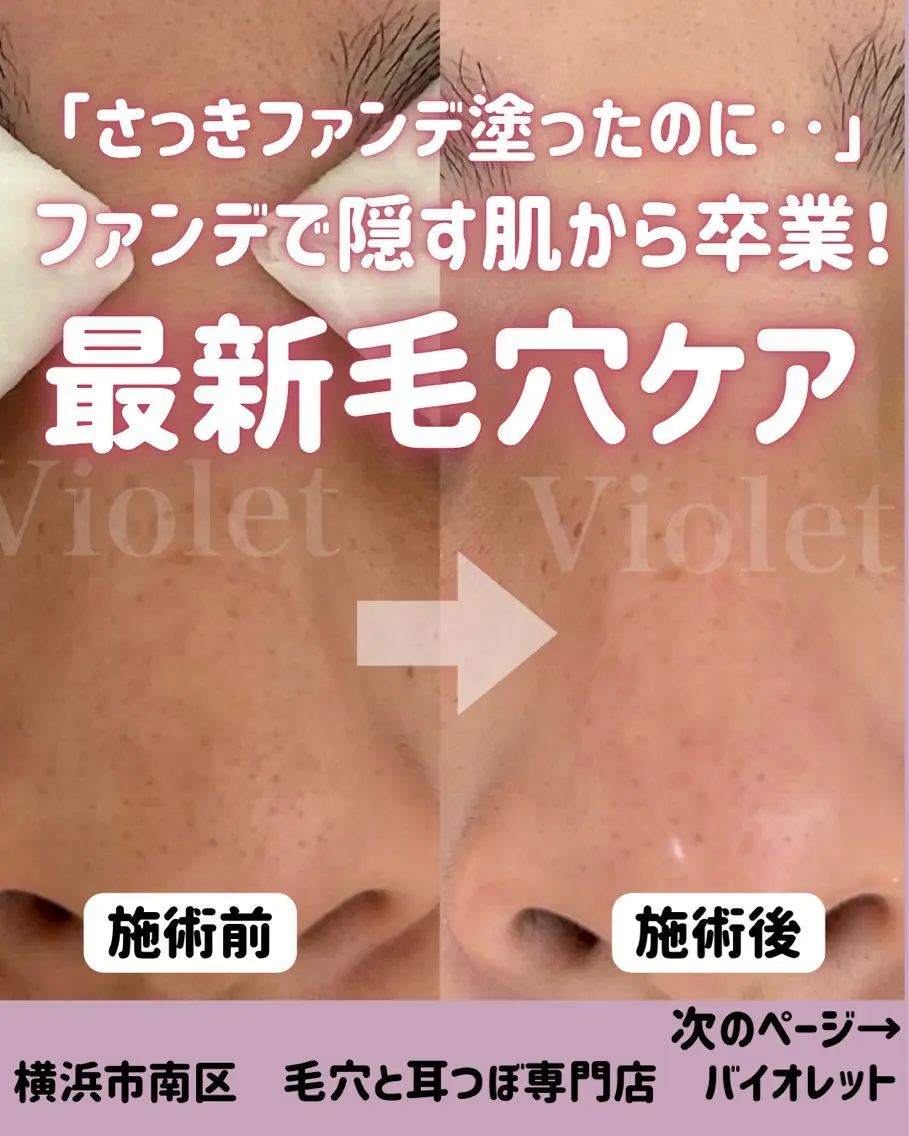 その他 毛穴と耳つぼ専門店 バイオレット　りののその他イメージ