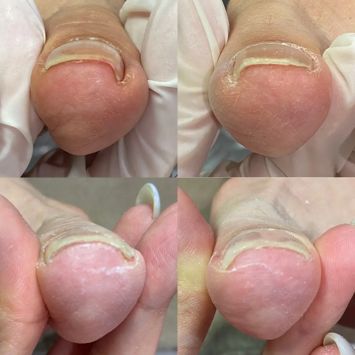 【初回カウンセリング無料】フット巻き爪補正(1ヶ所)の写真