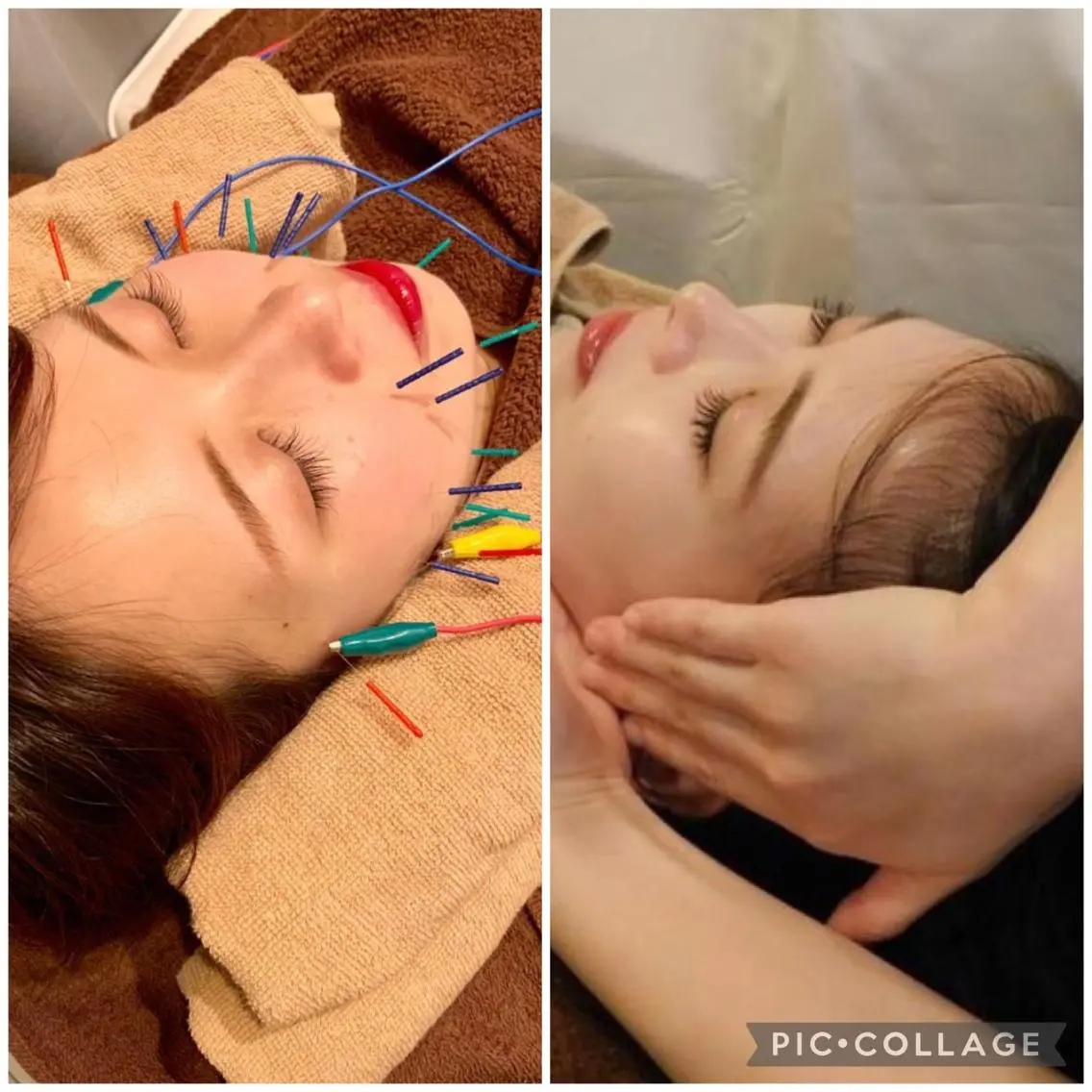【✨美容鍼+小顔矯正の大人気セット✨】お🉐な＂セット割＂💞美容鍼＋小顔美矯正💞の写真
