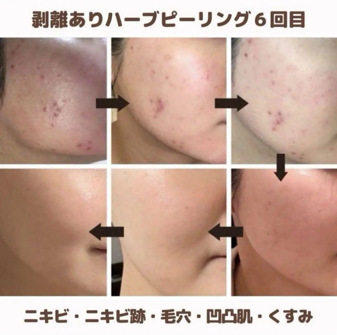 30日以内再来・肌質改善☆顔ハーブピーリング・剥離あり 美容液導入の写真