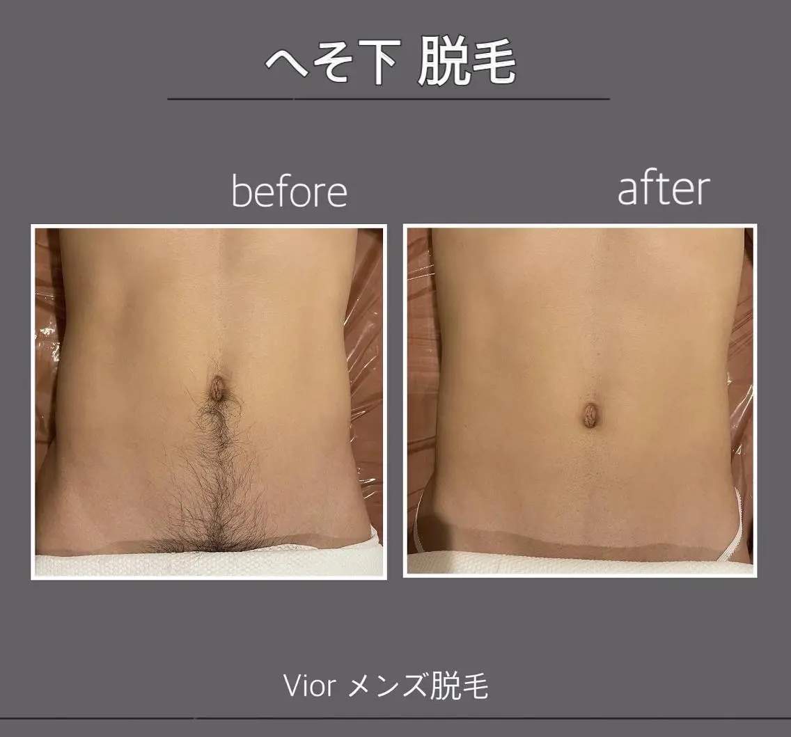 メンズ 脱毛 栄 VIO Rのエステ・リラクイメージ