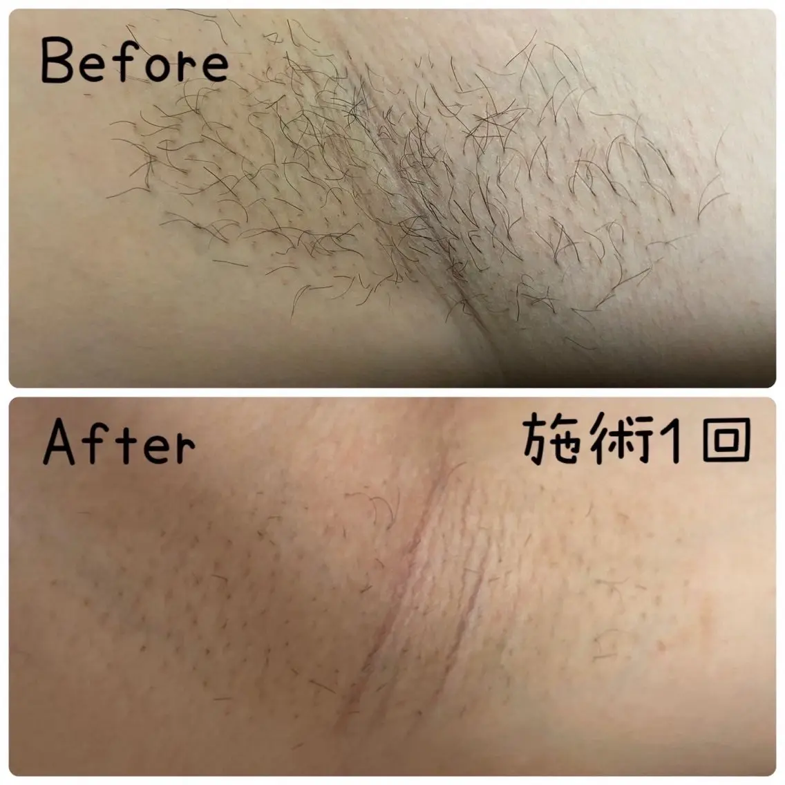 【レディース】結果重視!両わき美肌脱毛★ ¥2,200→¥1,100の写真