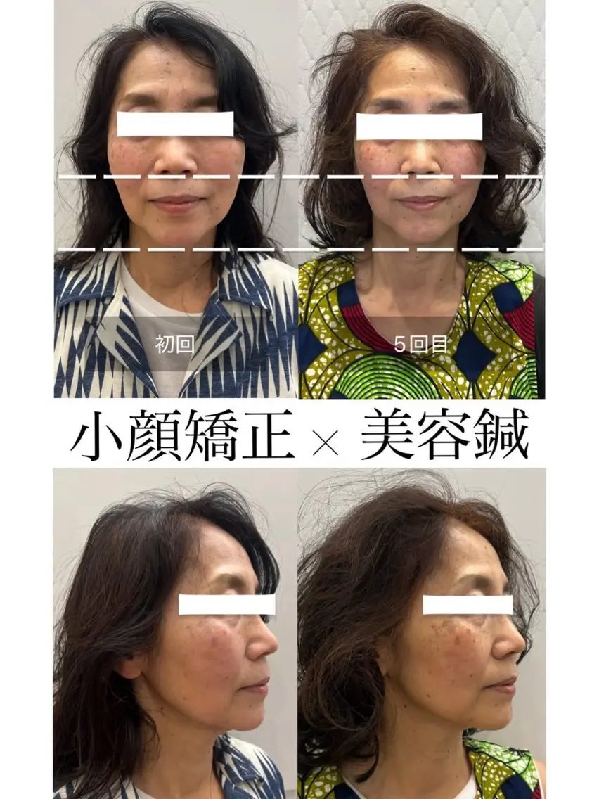【たるみ＆むくみ改善】小顔矯正＋メテオ 90分　16500円▶︎9900円の写真