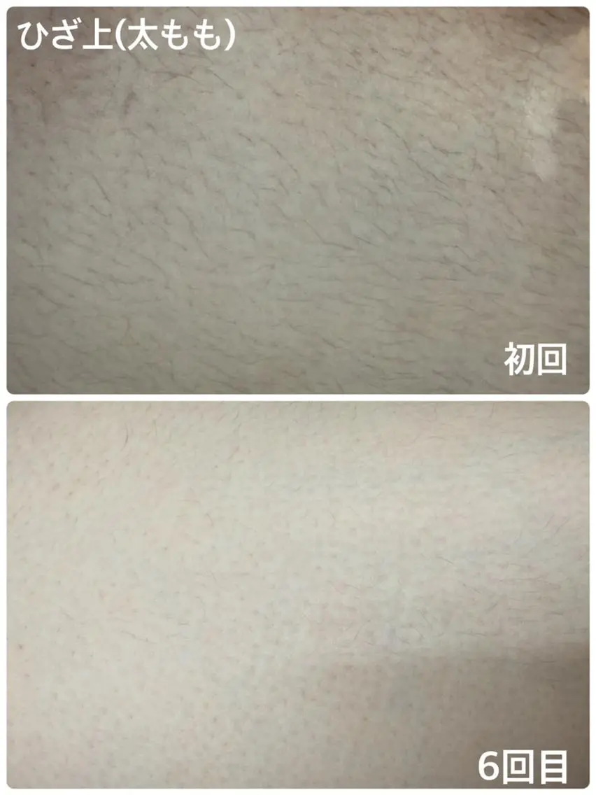 最新機械で痛みなしのVIO脱毛🎀安心安全シェービング付き✨の写真