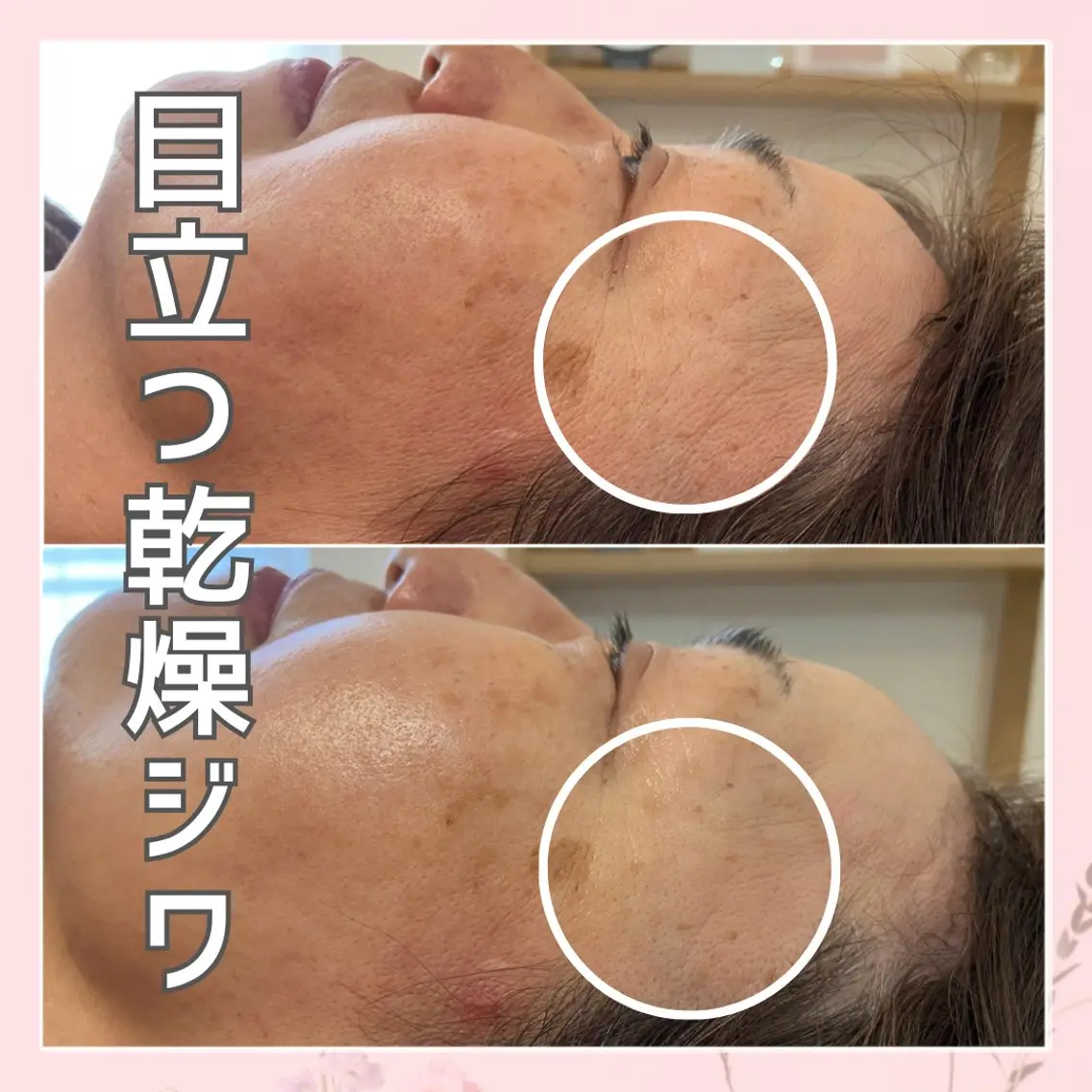 【小顔&美白】【ガッツリエイジングケアコース】盛り沢山🌟老廃物を流してスッキリ小顔&美白に!乾燥ジワたるみにも効果的!の写真