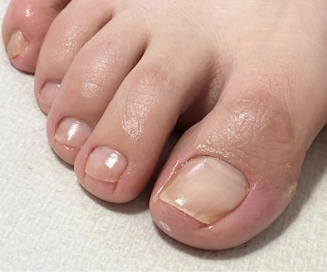 足の指先ケアの写真