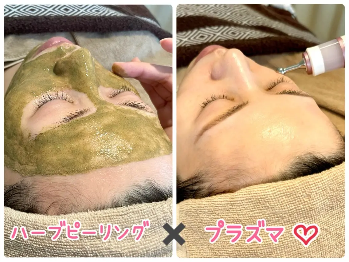 ★ミニモセール中✨ハーブとプラズマの力で肌改善💖ハーブピーリング🌿剥離なし💖ヒト幹細胞プラズマでノンストレス肌にの写真