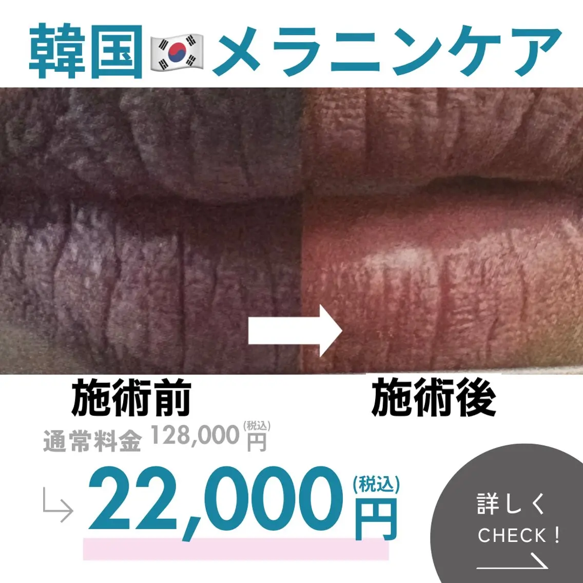 82%OFF話題沸騰韓国🇰🇷唇メラニンケア💋黒ずみ、くすみ一掃で透明感UP✨ダウンタイムなし今すぐ変わりたい方への写真