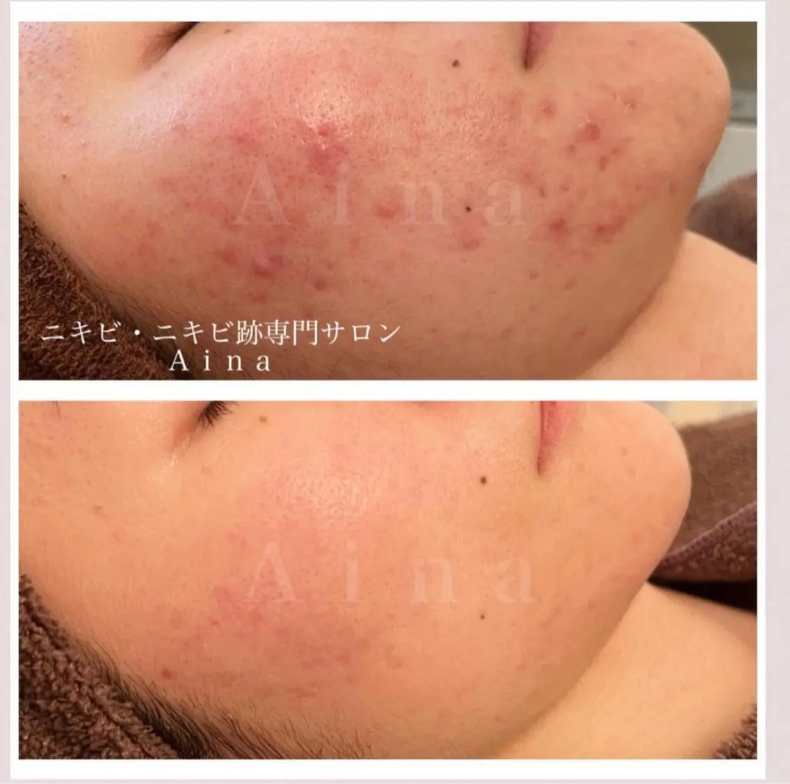 ショート カラー パーマ ヘアアレンジ メンズ キッズ ネイル マツエク・マツパ アイブロウ 赤色 エステ リラク ニキビ跡専門サロン Ainaのエステ・リラクイメージ