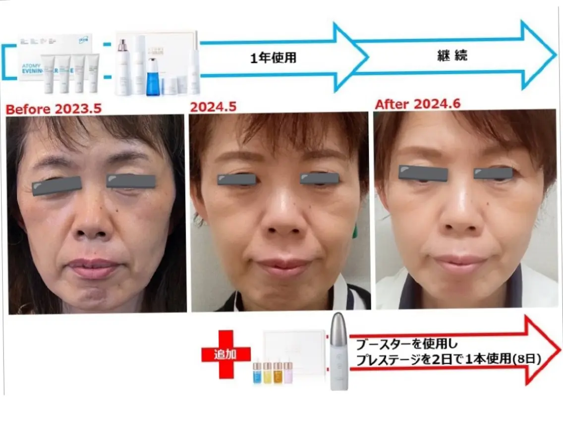 集中美容液導入コース(開封した4種はお持ち帰り)の写真