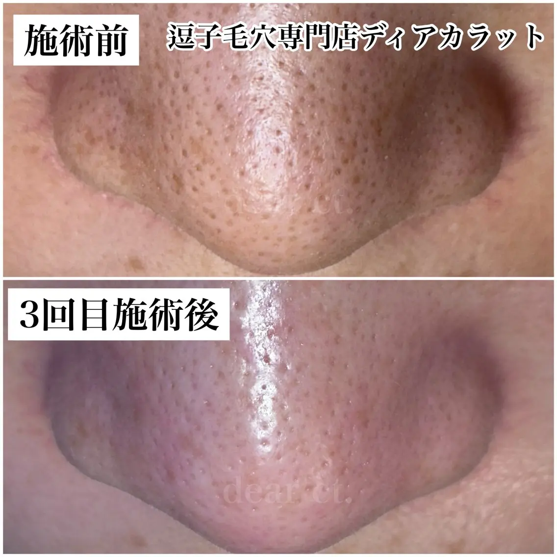 毛穴美コース　お着替えなし70分　リピーター様割引ありの写真