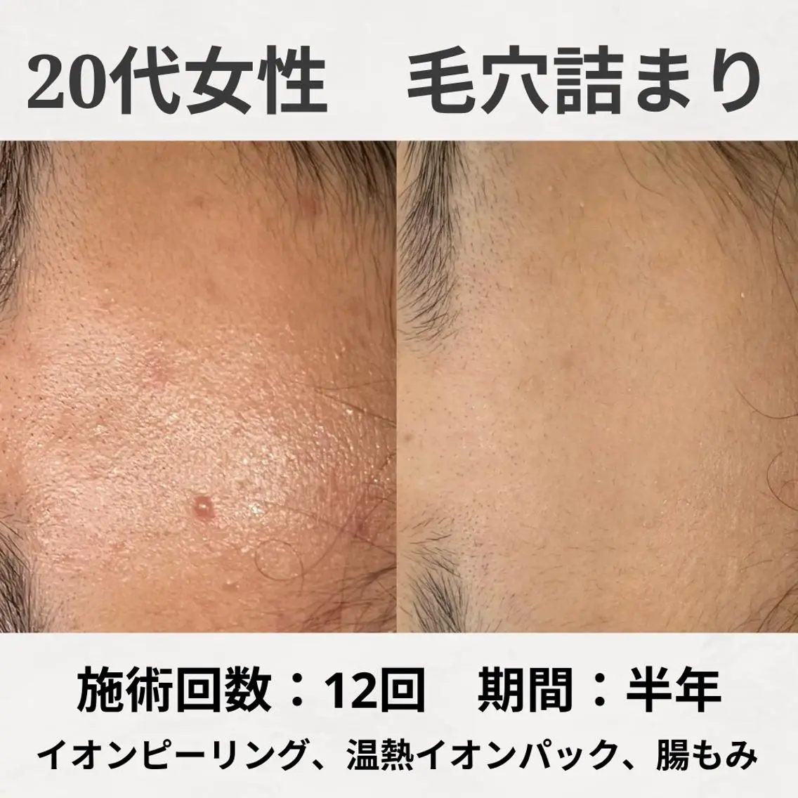 エステ リラク ニキビ跡改善専門🔥 医療にはできない改善のエステ・リラクイメージ