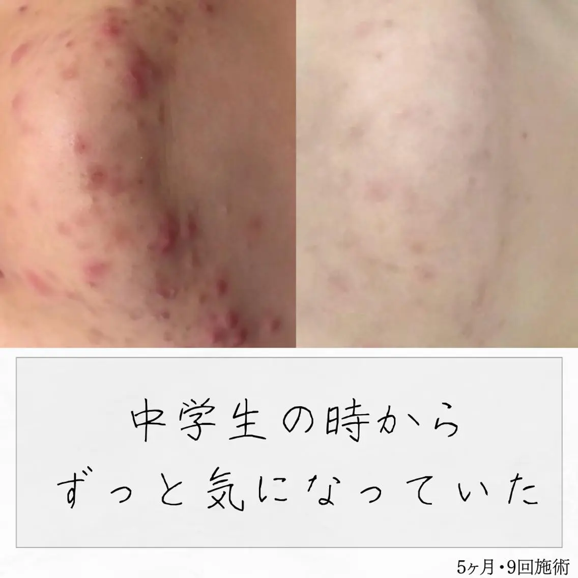 ニキビ経験者が施術 する専門サロン🌻のエステ・リラクイメージ