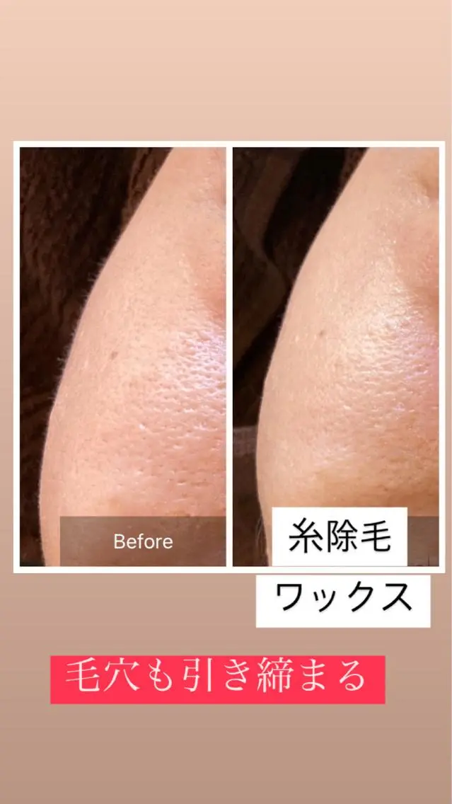 フェイスWax（2ヶ月以内）の写真