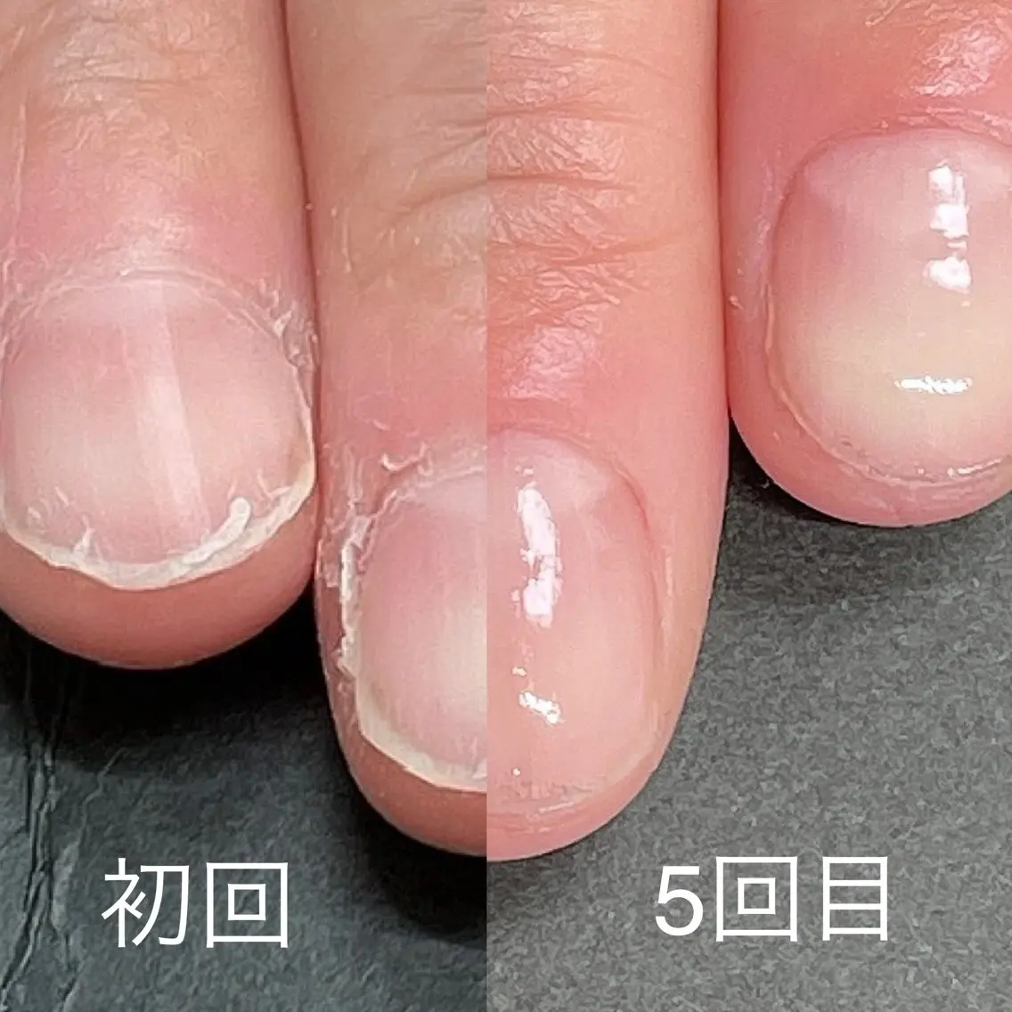 自爪育成／最強ケアお試し(１回)／オフ込みの写真