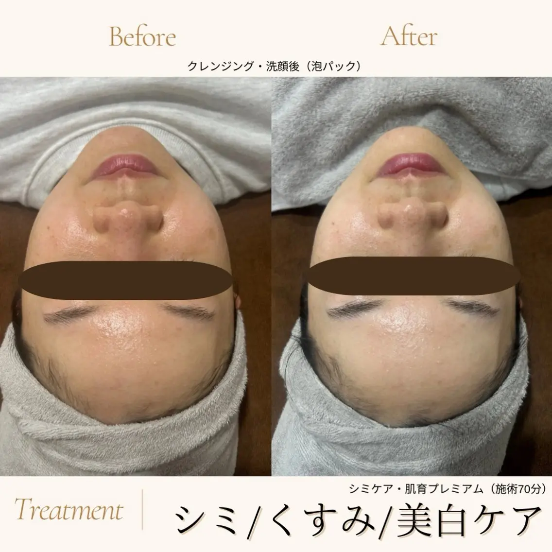 【小顔リフトアップ60分】🌻毛穴洗浄×ポレーション（美白&保湿美容液）×特許波形EMSの写真