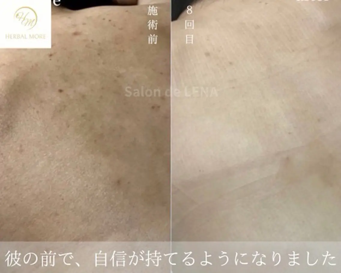 その他 ハーブピーリング 専門店/名古屋駅前店のエステ・リラクイメージ