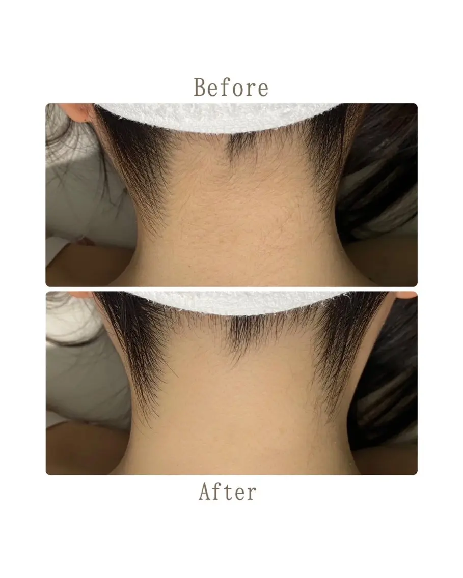 【 脇+うなじ+背中上脱毛🫧 】水着/前撮り/ウエディング/卒業式/入学式の写真