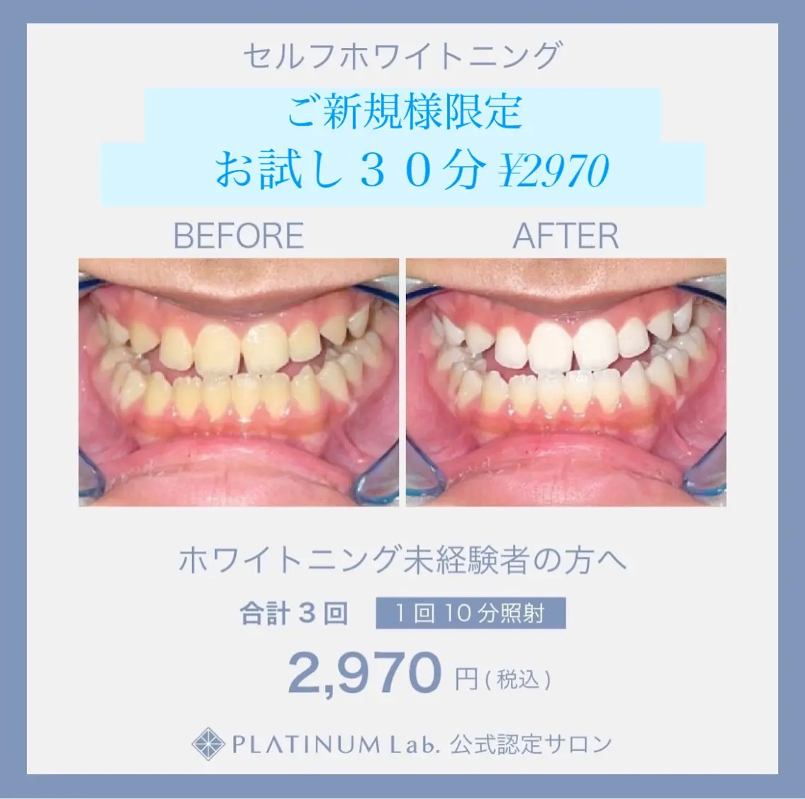 ご新規様限定🦷セルフホワイトニングお試し30分✨自然な清潔感ある白さを目指していきます💎メンズも大歓迎✨ ☝️の写真