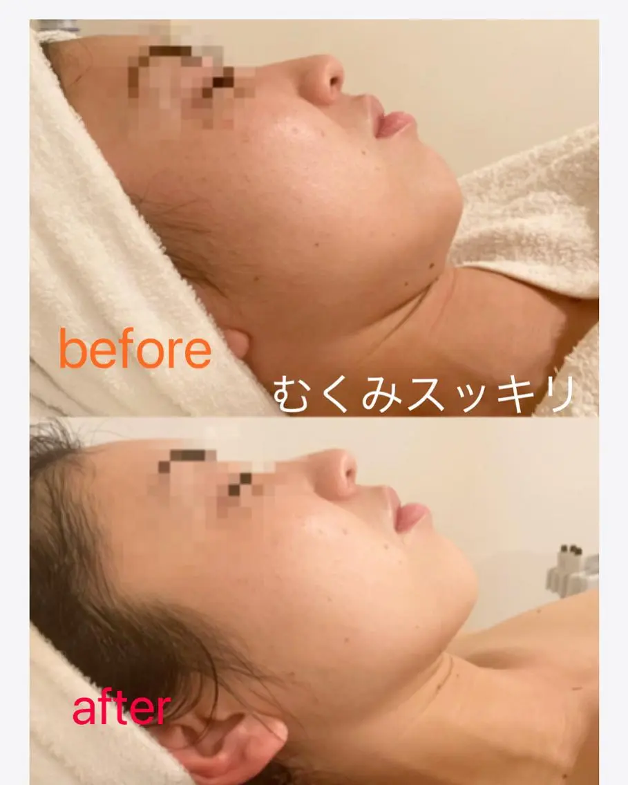 新BAエイジング美白ケア☆複合的お肌悩みを徹底的にアプローチ☺︎POLA最高峰のBA美容液たっぷり入れ込め大満足☆の写真