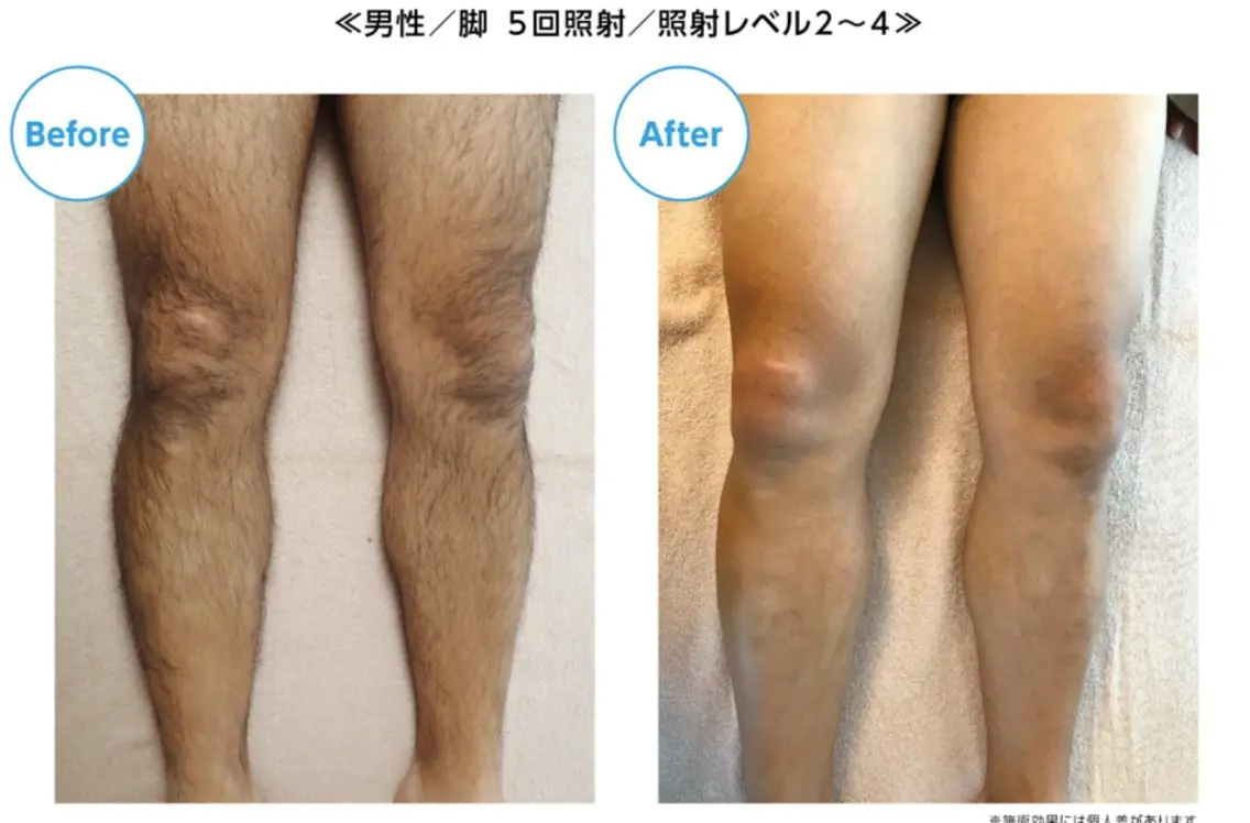 【足全体脱毛】冬の間に脚ツルツル✨メンズ専用の写真