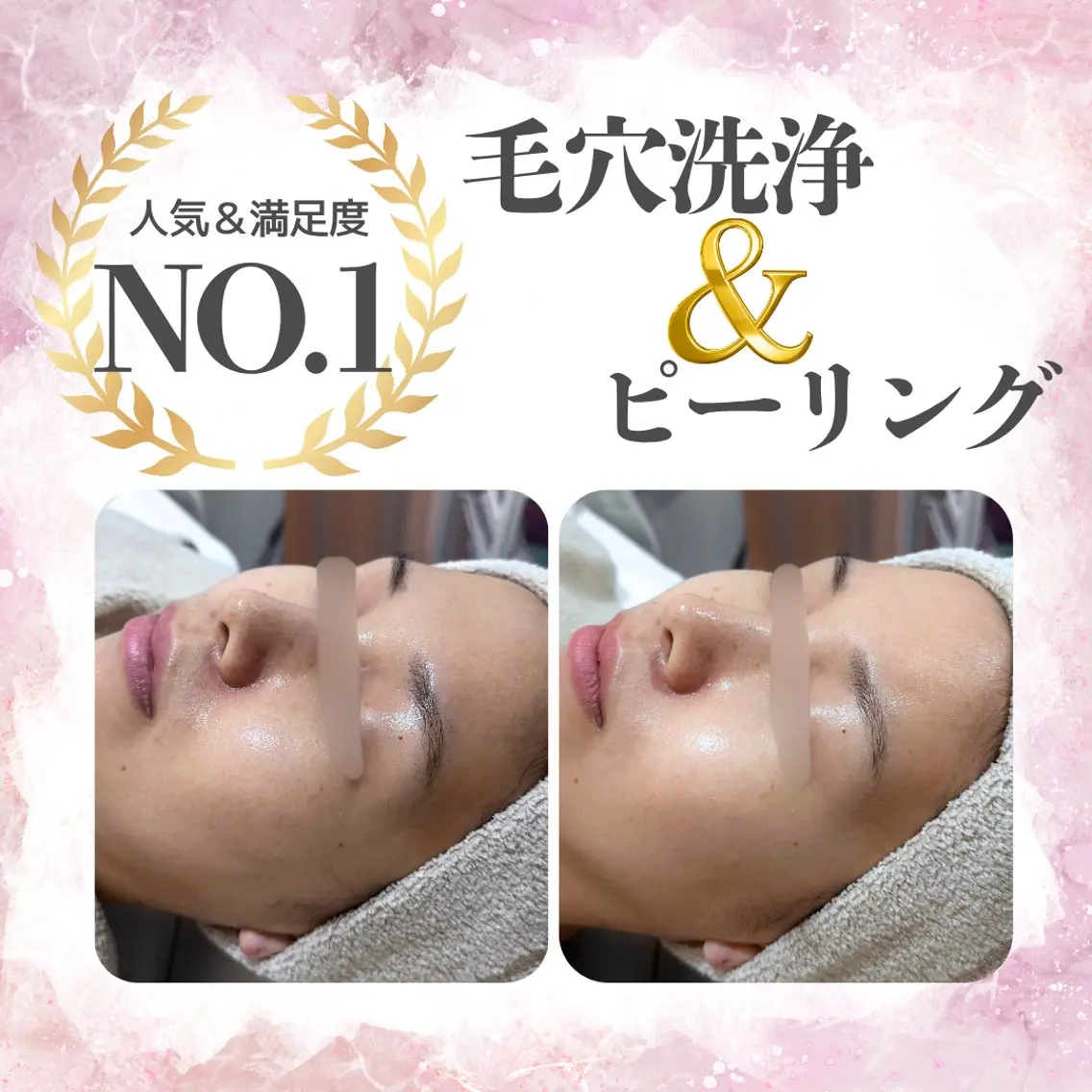 〈大人気🎀平日割🤍〉お好きなピーリング➕毛穴洗浄🫧の写真