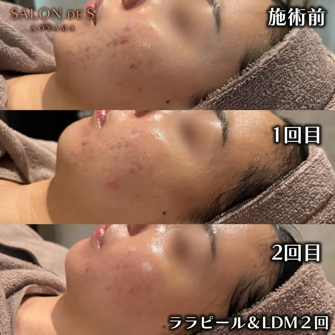 ♡韓国肌管理ララピール×水玉LDM♡どこよりも結果の出る根本改善体験❕つるん肌＆毛穴レス🫧韓国美肌管理の新常識♡の写真