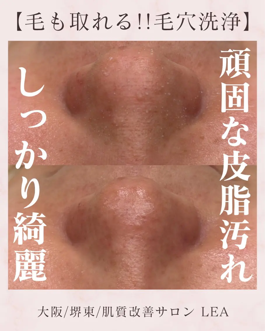 エステ Lea堺東　　眉毛| 毛穴洗浄|顔WAXのその他イメージ