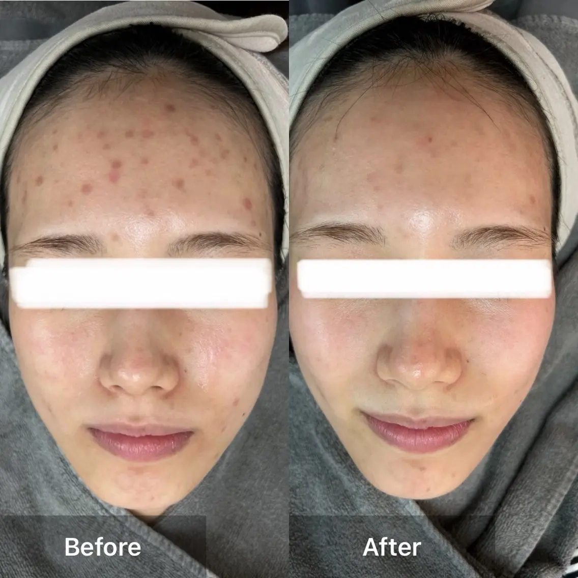 🌿剥離あり・なしハイブリッドハーブ✨【剥離あり・なし】【毛穴洗浄】【美容液】ニキビ/ニキビ跡/黒ずみ/水光肌/毛穴ケアの写真