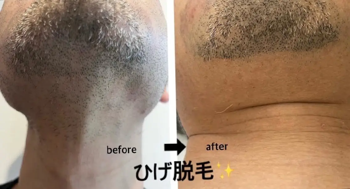 脱毛 看護師 桐山 まどかのエステ・リラクイメージ