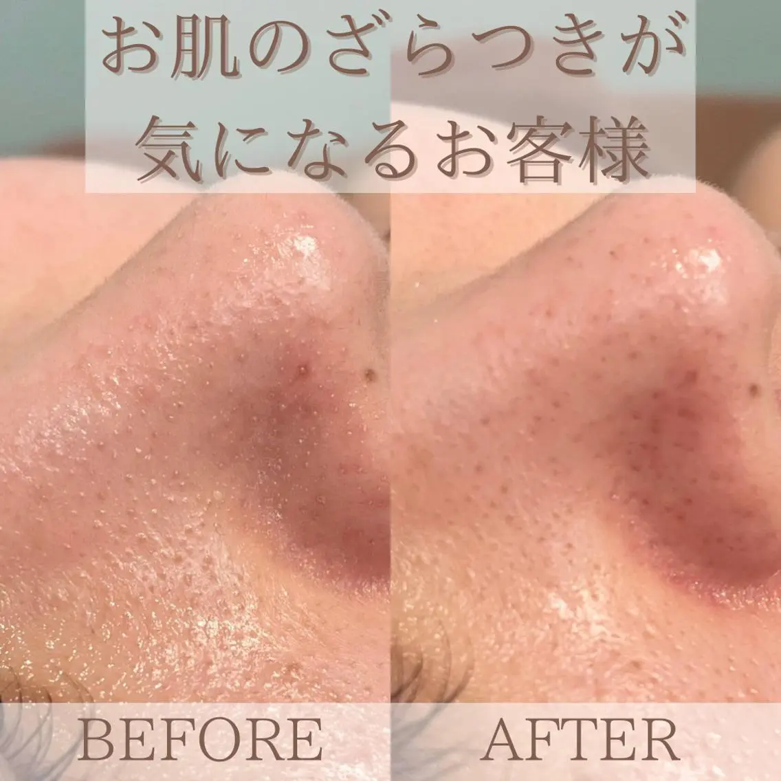【モニター募集】ハイドラ✯毛穴洗浄とビタミン導入☆通常8,500円▶︎7,200円の写真