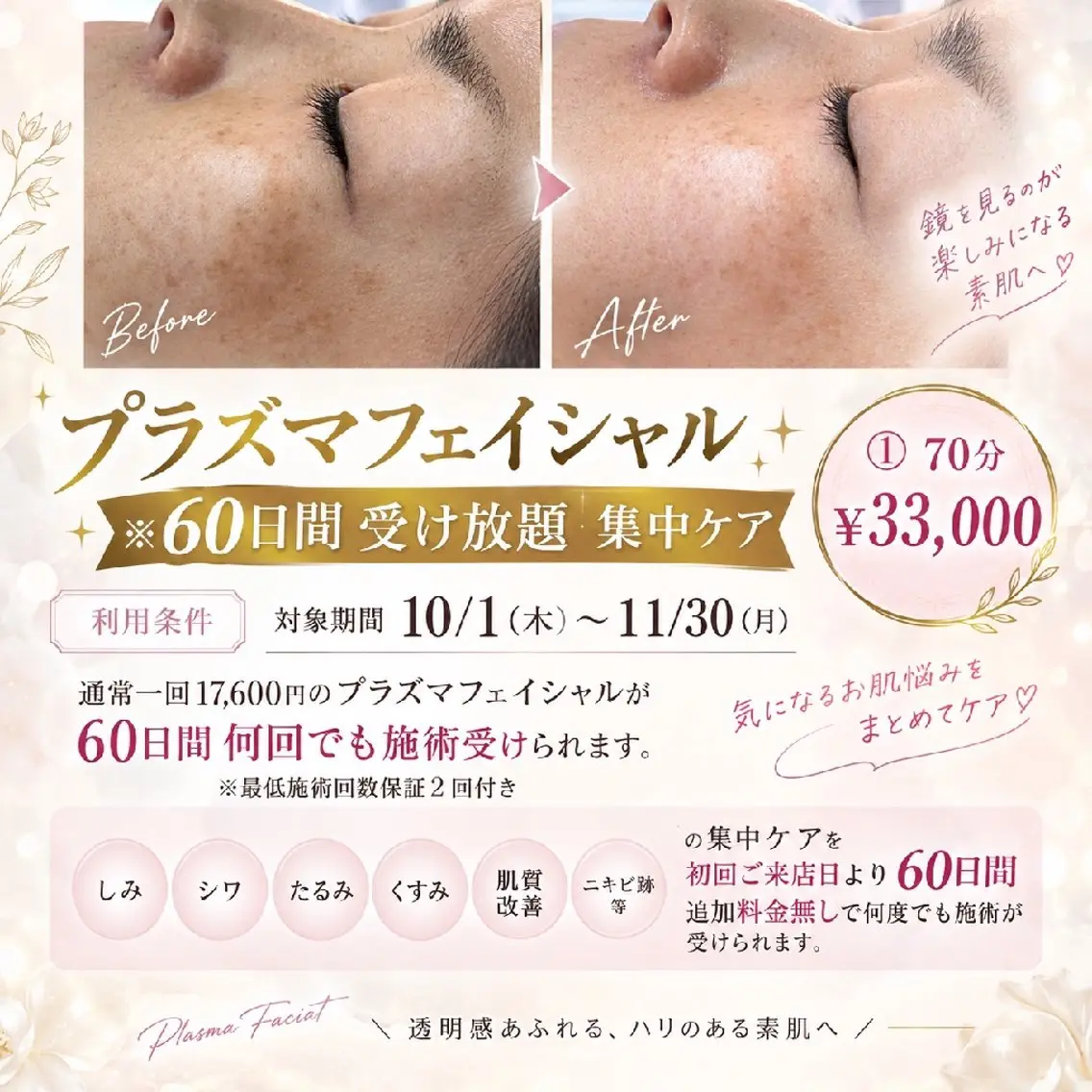 プラズマフェイシャル※60日間受け放題集中ケアの写真
