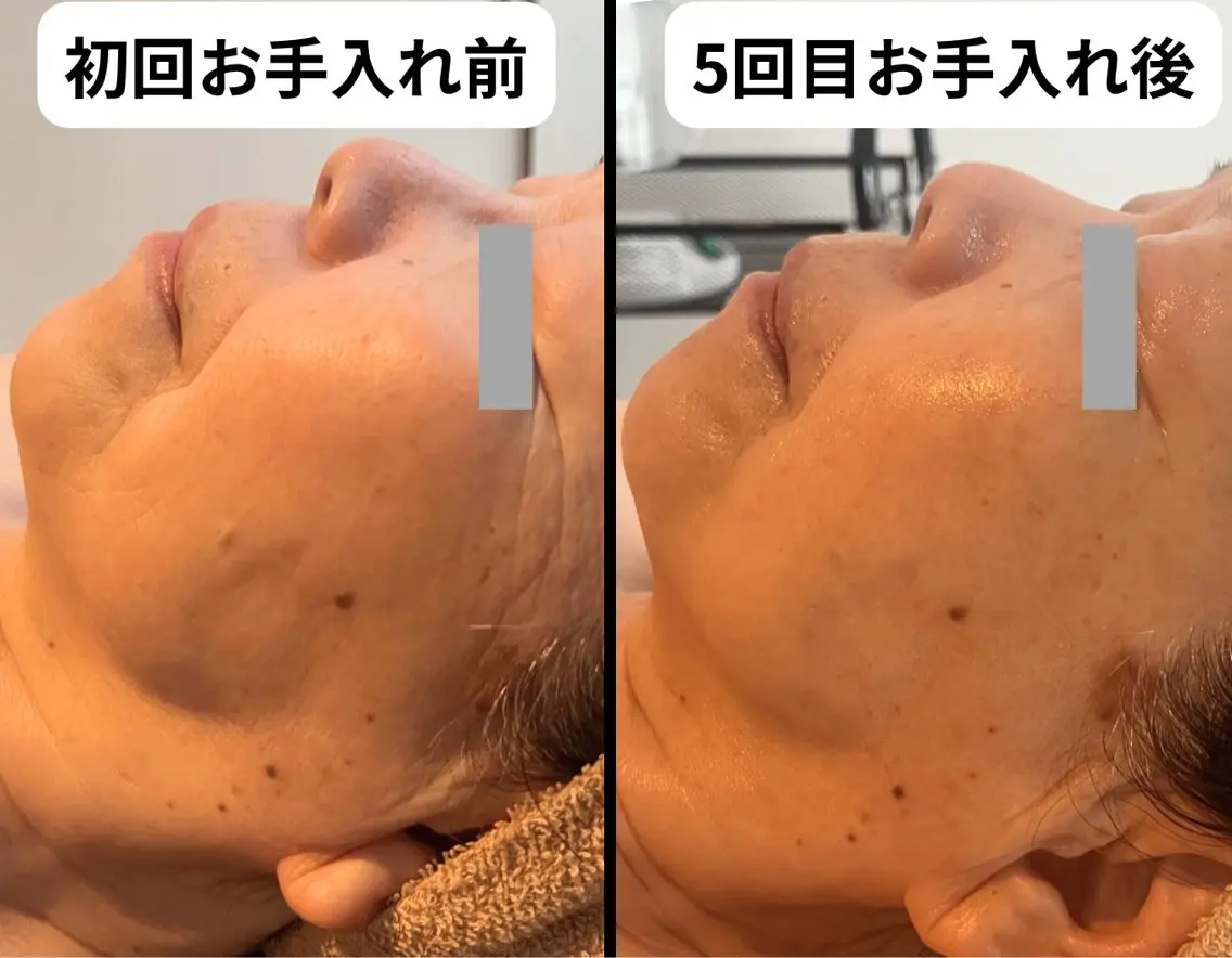 ⭐ 温感ほぐし × 筋肉ケアで整えるプレミアムフェイシャル（120分）の写真