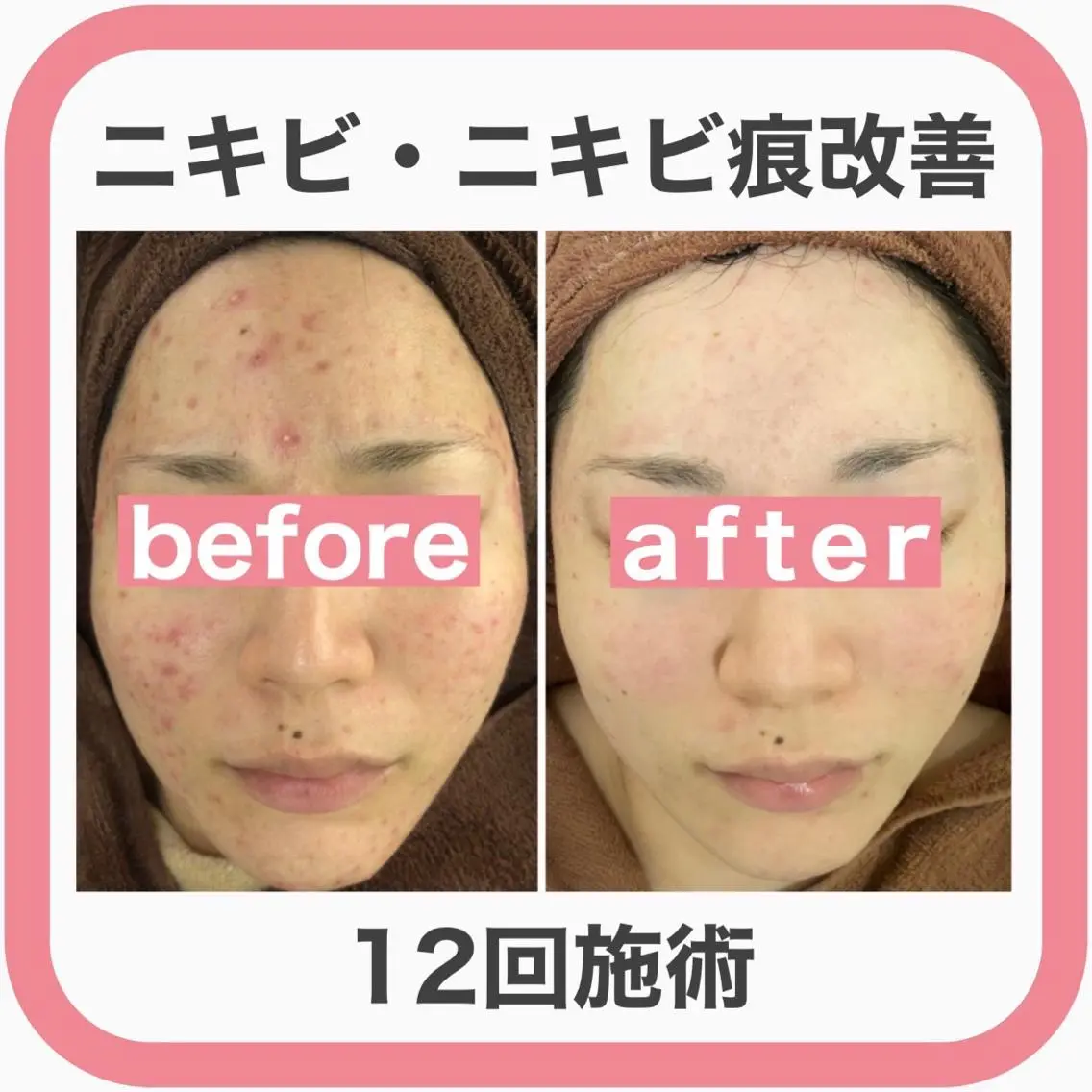 セミロング カラー パーマ ヘアアレンジ メンズ キッズ ネイル マツエク・マツパ アイブロウ 3か月で肌革命👼 ニキビ専門店💫のエステ・リラクイメージ