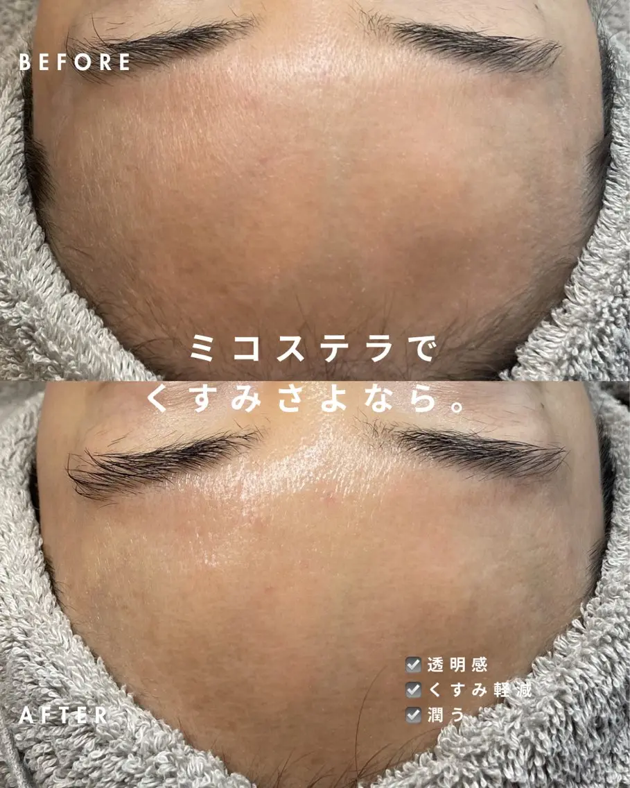 【お試し💉くすみしみ撃退】次世代肌育ジェットで即効美白の写真