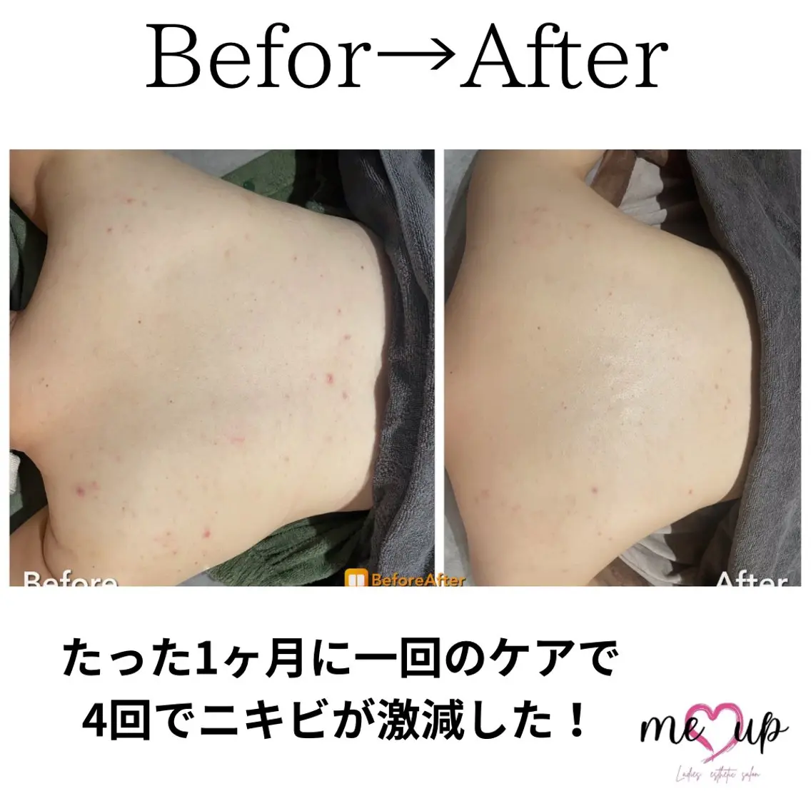 エステ Meupニキビ専門店 背中/ハーブ/肌管理のその他イメージ