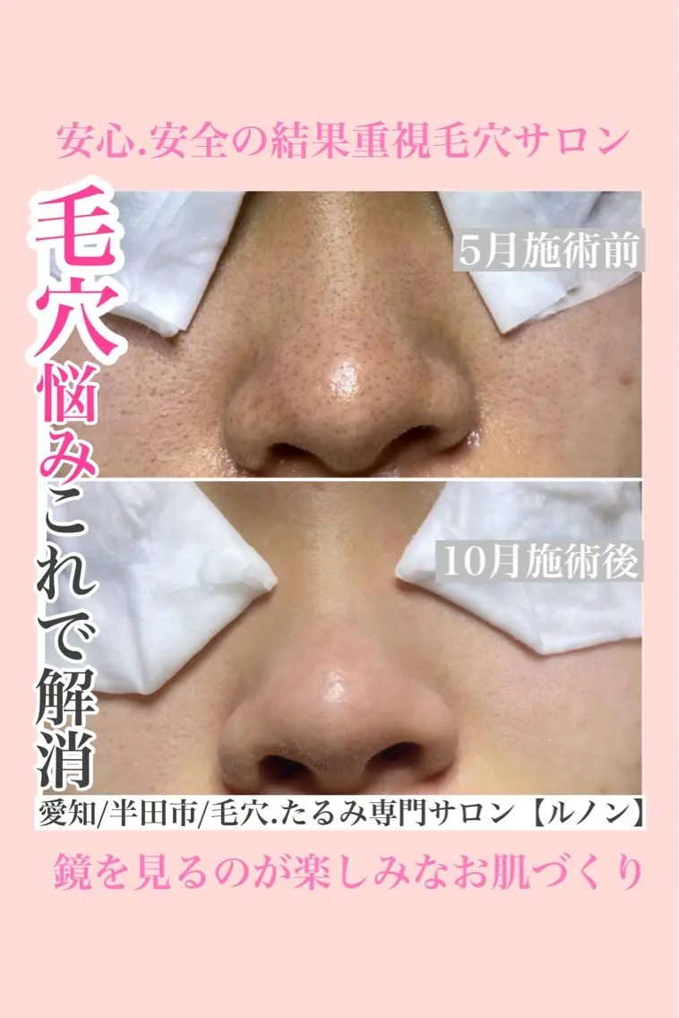 毛穴エクストラクションプロの毛穴美人コースの写真
