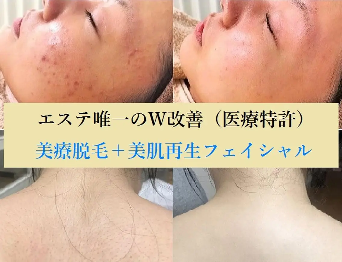 顔脱毛&毛穴&ニキビ 優良№1♪ヒロコ♪のエステ・リラクイメージ