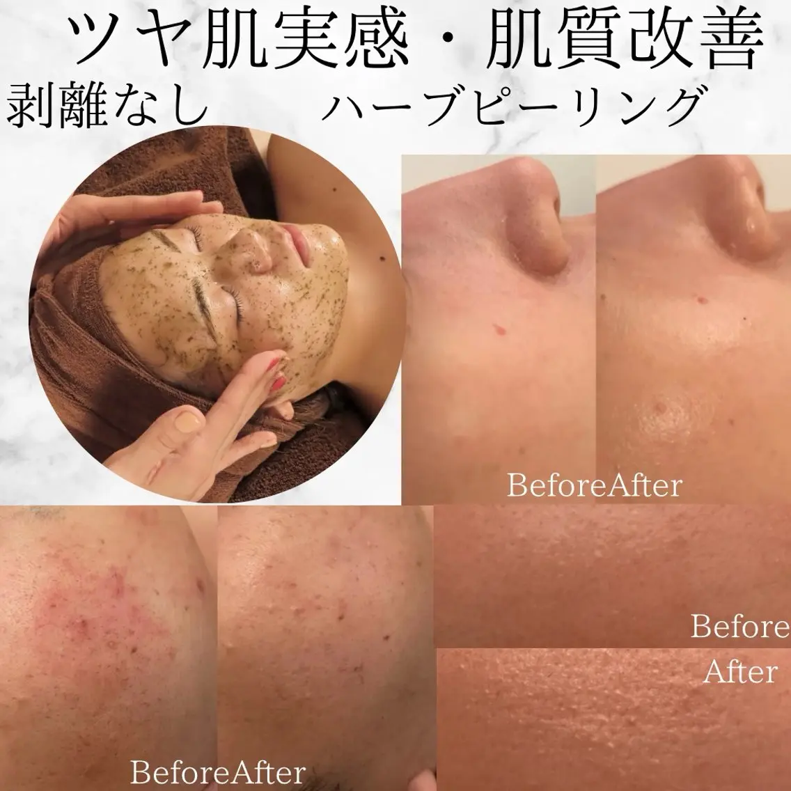 【特別クーポン★説明必読】幹細胞ハーブピーリング🌿肌質改善◎お試し水光肌の写真